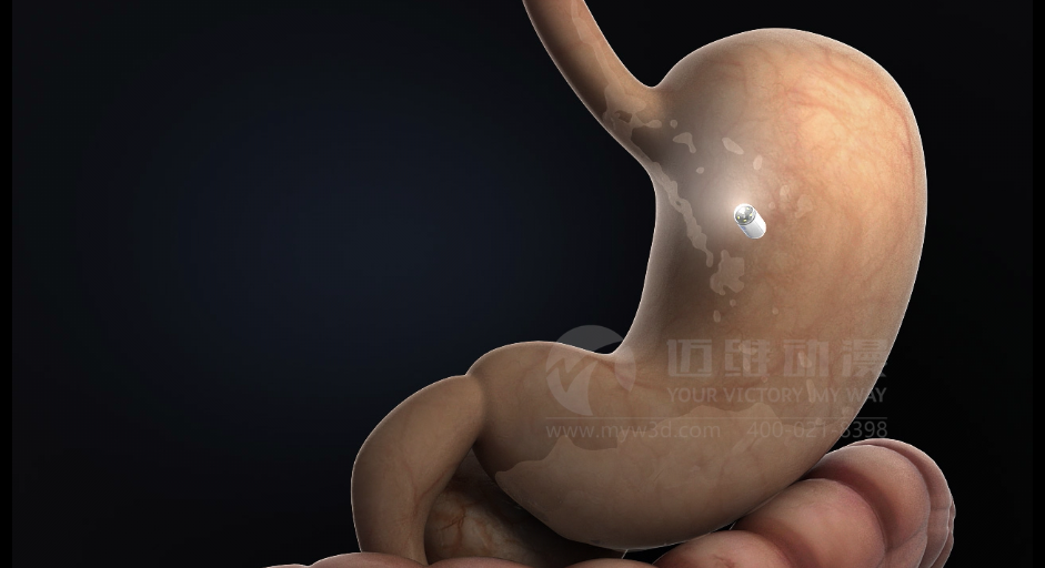 醫(yī)學(xué)醫(yī)療三維動(dòng)畫 醫(yī)學(xué)醫(yī)療三維動(dòng)畫