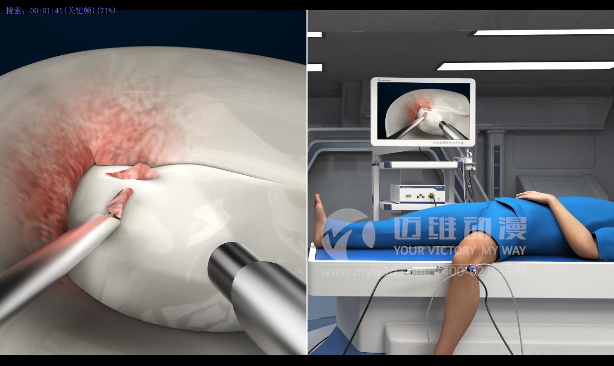 人體手術(shù)三維動(dòng)畫(huà).jpg 人體手術(shù)三維動(dòng)畫(huà).jpg